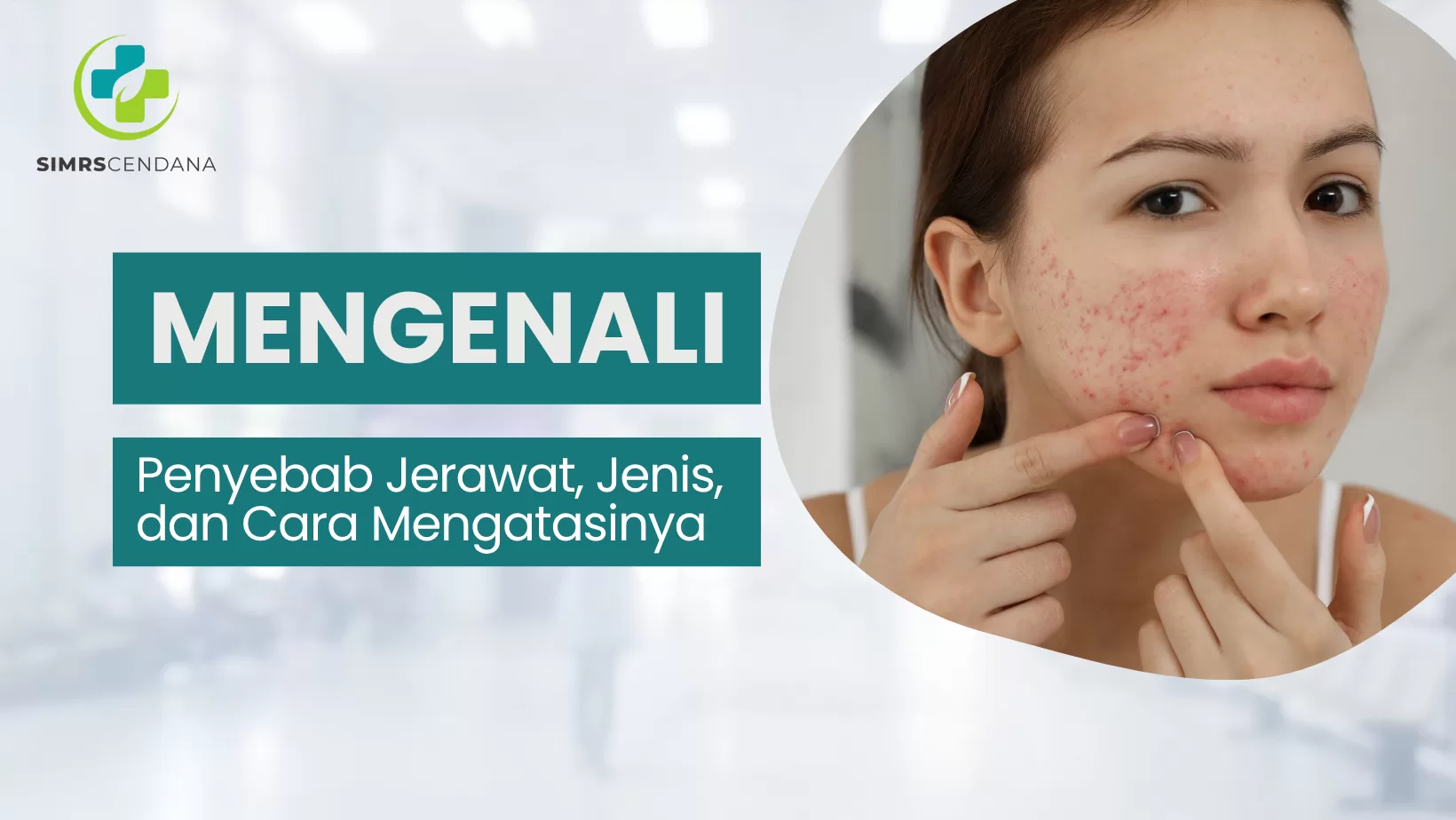 Penyebab Jerawat, Jenis, dan Cara Mengatasinya Secara Efektif